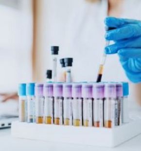 Covid-19, test sierologici fondamentali per screening e valutazione epidemiologica Covid-19, test sierologici fondamentali per screening e valutazione epidemiologica