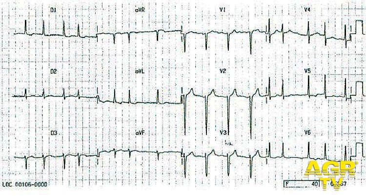 Fibrillazione atriale Fibrillazione atriale