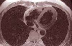 MEDICINA: SOSTITUITA VALVOLA CUORE