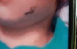 Lividi sul volto del bambino