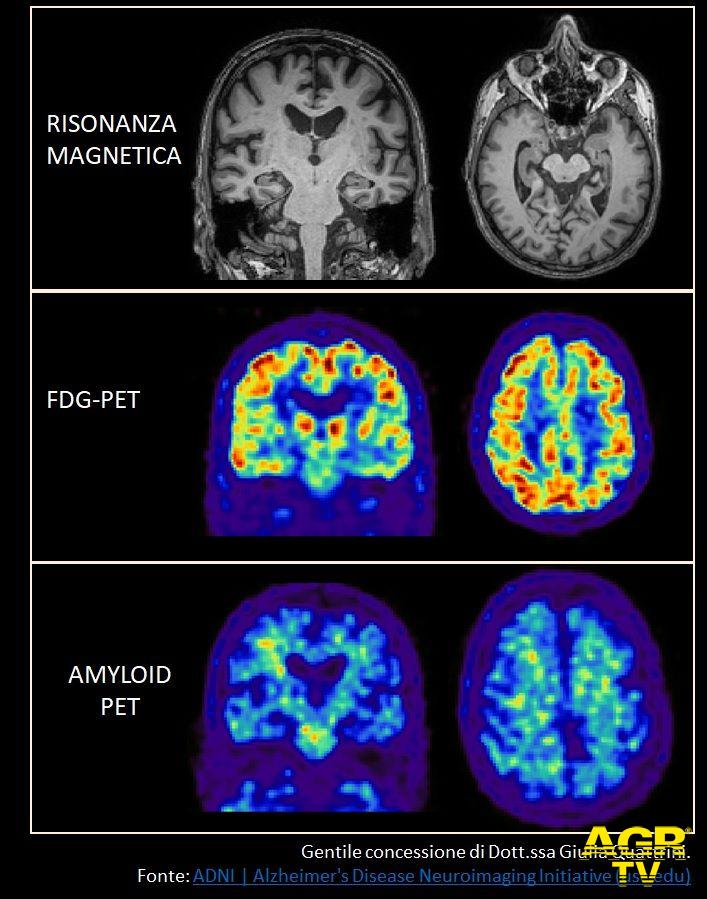 l'immagine permette di confrontare le informazioni che il medico ricava da MRI, FDG-PET e amy-PET. Le immagini sono state tutte estratte da un database open (ADNI) citato come fonte. 