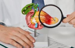Tumore del pancreas: la diagnosi precoce può fare la differenza