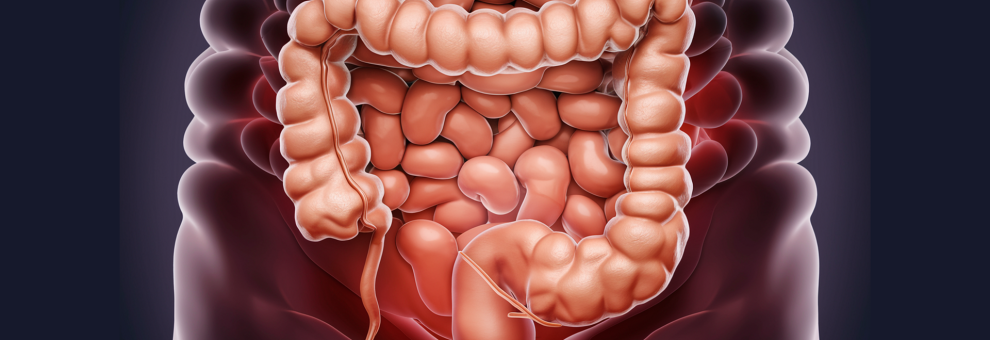 Sanità, tumore del colon in aumento tra i giovani, in Italia oltre 50 mila casi