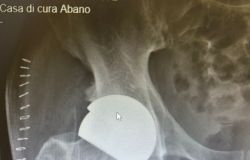 PROTESI_CERAMICA_-_RX