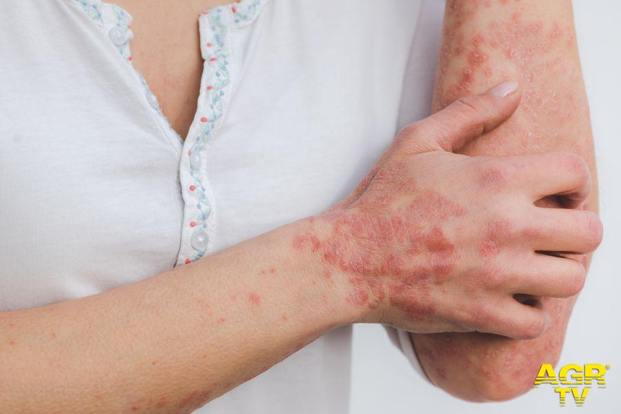 Immagine di Eszter Miller da Pixabay dermatiti Immagine di Eszter Miller da Pixabay dermatiti