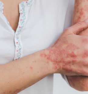 Dermatite atopica, sono 3 milioni gli italiani colpiti Dermatite atopica, sono 3 milioni gli italiani colpiti