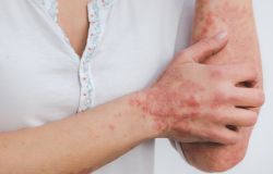 Dermatite atopica, sono 3 milioni gli italiani colpiti