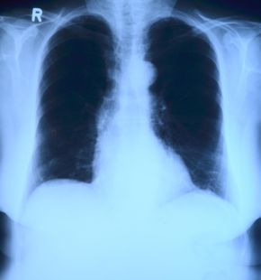 Roma, Tumore del polmone, l’importanza della diagnosi precoce: al San Camillo 28 casi individuati su 939 TAC Roma, Tumore del polmone, l’importanza della diagnosi precoce: al San Camillo 28 casi individuati su 939 TAC